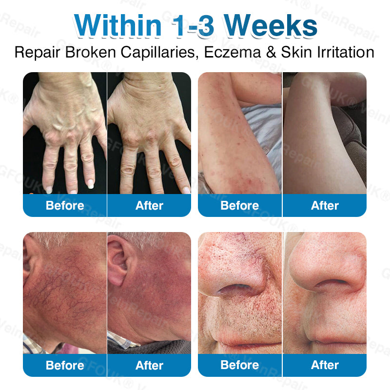 NEYEROS® VeinRepair Microneedle Patch Roll⚡Instant Relief, Long-Term Results