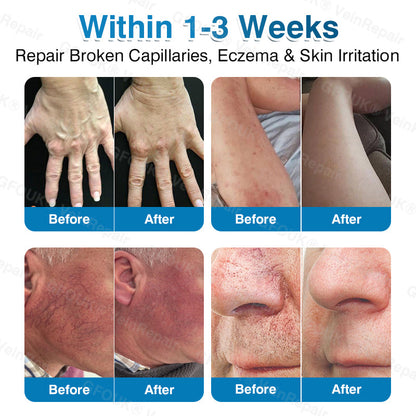 NEYEROS® VeinRepair Microneedle Patch Roll⚡Instant Relief, Long-Term Results