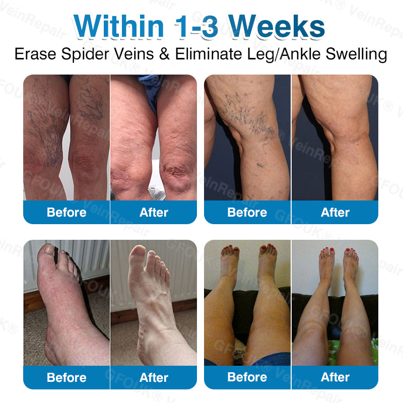 NEYEROS® VeinRepair Microneedle Patch Roll⚡Instant Relief, Long-Term Results