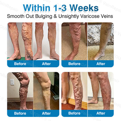 NEYEROS® VeinRepair Microneedle Patch Roll⚡Instant Relief, Long-Term Results